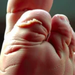 Featured: Does Diabetes Cause the Top of Your Feet to Itch?